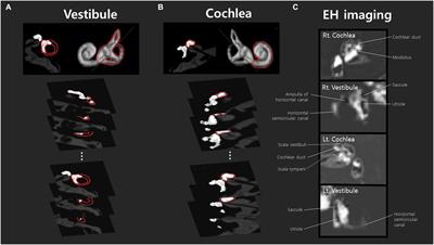 Endolymphatic hydrops asymmetry distinguishes patients with Meniere’s disease from normal controls with high sensitivity and specificity